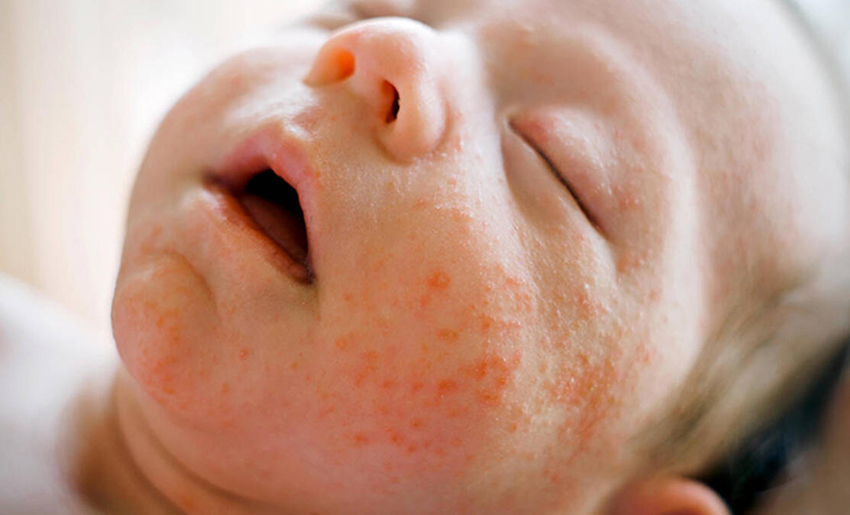 Bebeklerde Atopik Dermatit (EGZAMA) Belirtileri  ve Tedavi Yöntemleri